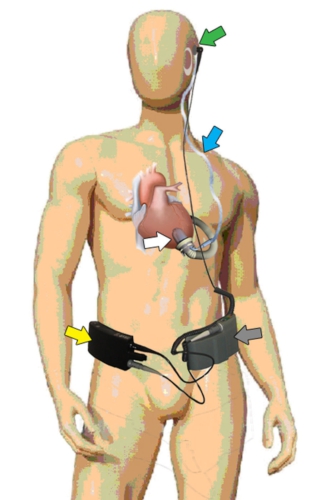 FDA Approves Trial Using Jarvik 2000 Heart as a Destination